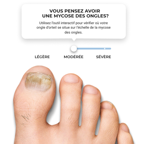 Ressource sur l’échelle de la mycose des ongles d’orteil