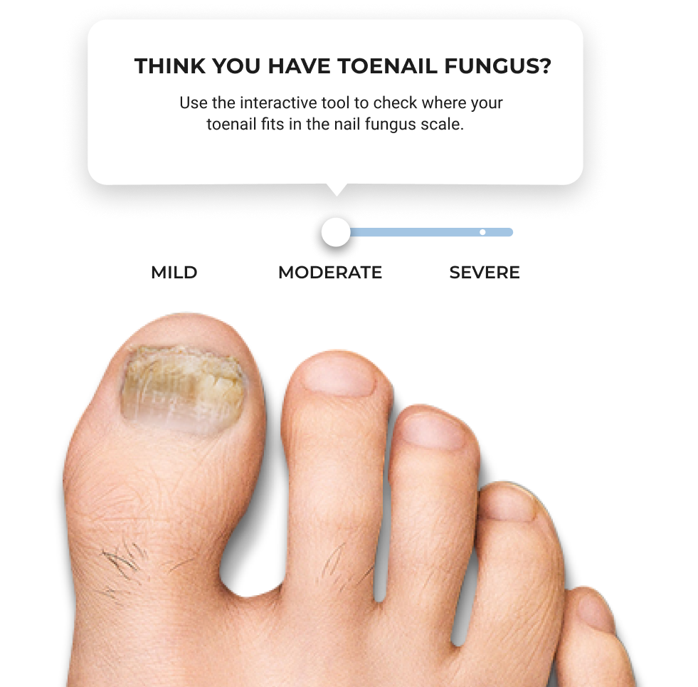 Fungal Toenail: Symptoms, Causes & Treatment | The Foot Hub