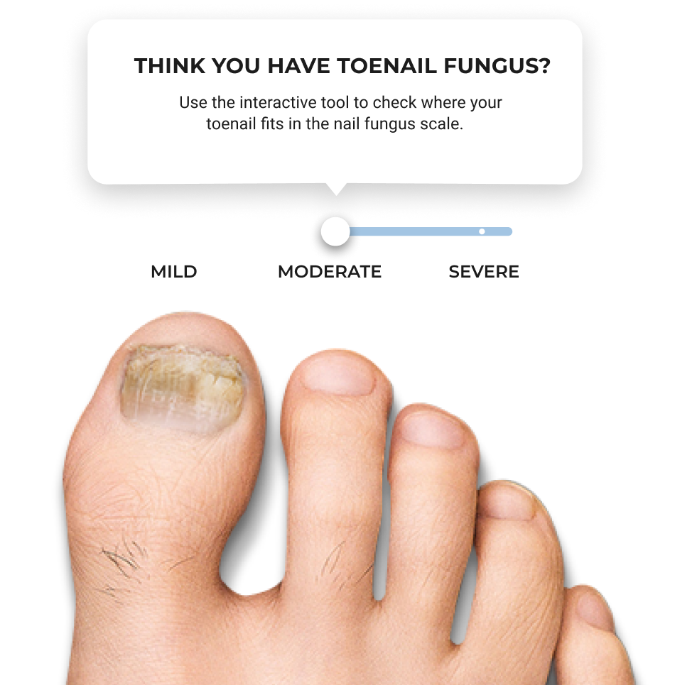 Fungal Nail Infections