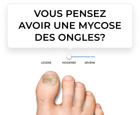 Ressource sur l’échelle de la mycose des ongles d’orteil