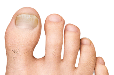 Foot with toe fungus