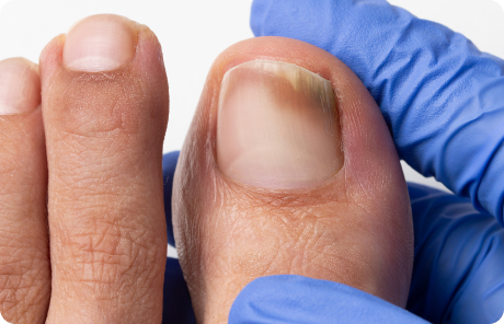 Nail Fungus | What is toenail fungus?